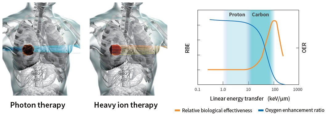 Image of Toshiba Heavy Ion Therapy System targeting tumor in the chest area.
